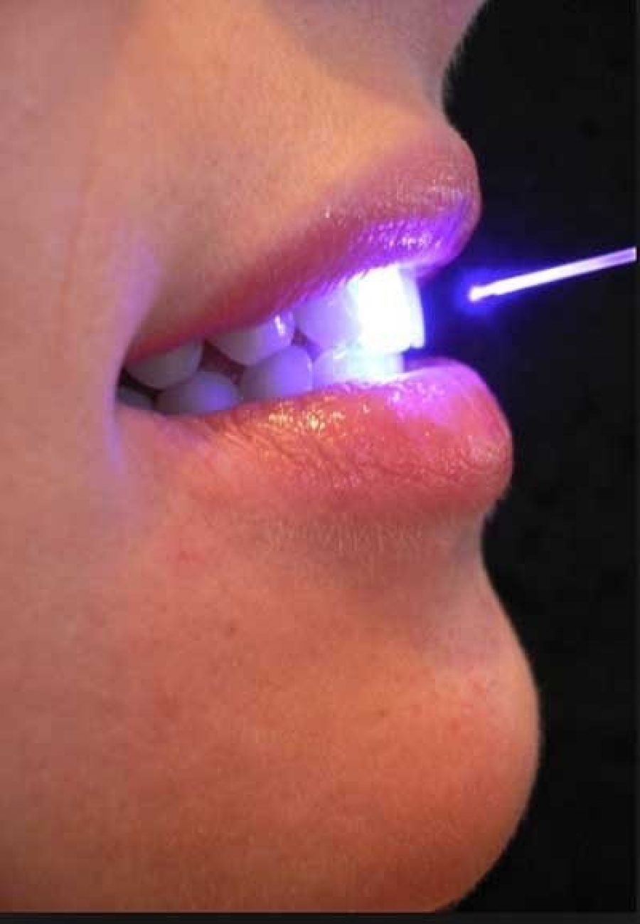 Penna laser a diodi in odontoiatria 400μm per Odontoiatri e Dentisti 